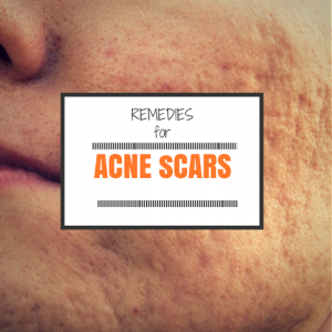 5 Proven Home Remedies for Acne Scars (That Work)